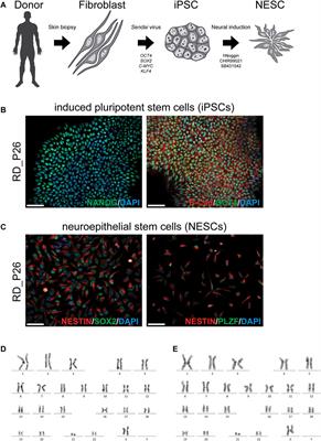 Partial Monosomy 21 Mirrors Gene Expression of Trisomy 21 in a Patient-Derived Neuroepithelial Stem Cell Model